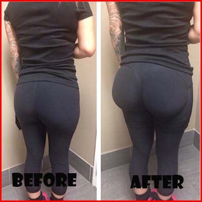 Before and After Butt Lifter Sample 2